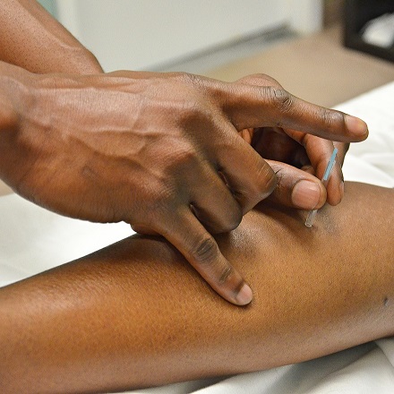Acupuncture